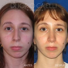 Rinoplastia - Di Iorio - Cajelli