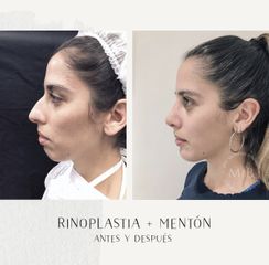 Rinoplastia + mentoplastia - Dra. Mariana Bouvier