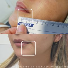 Cierre de orificio de piercing - Dra. Natalia Solimano