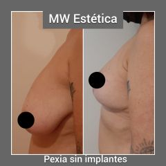 Pexia (levantamiento mamario) sin implantes - Mw Estética