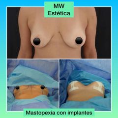 Mastopexia - Mw Estética