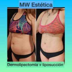 Dermolipectomía - Mw Estética