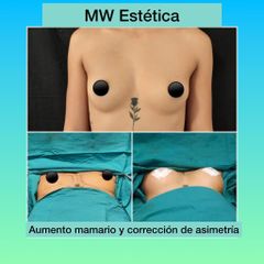 Aumento mamas - Mw Estética