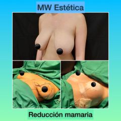 Reducción de mamas - Mw Estética
