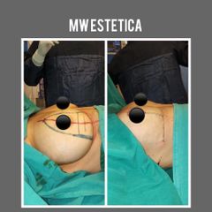 Reducción de mamas - Mw Estética
