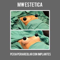 Mastopexia - Mw Estética