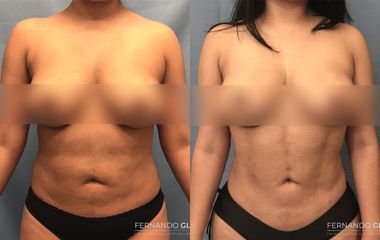 Lipoescultura - Dr. Fernando Glaria