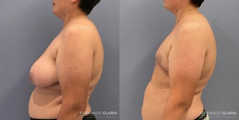 Mastectomía por Reasignación de Género - Dr. Fernando Glaria