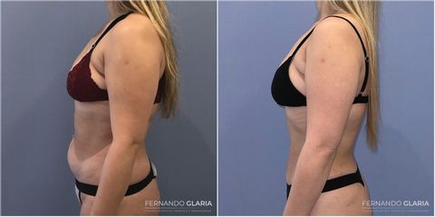 Liposucción - Dr. Fernando Glaria