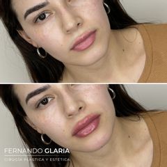 Relleno de labios - Dr. Fernando Glaria
