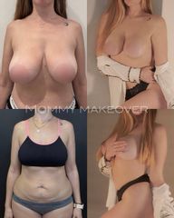 Mommy Makeover - Dr. Fernando Glaria