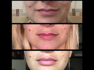 Simetrización - Perfilado - Relleno de labios con ácido hialurónico
