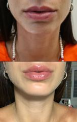 Relleno de labios - Dr. Leandro Di Carlo