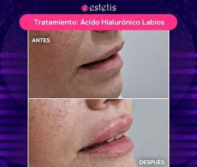Labios Ácido Hialurónico - Estetis
