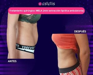 MELA - Estetis