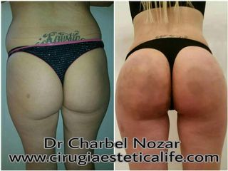 Lipoescultura con Lipotransferencia glutea
