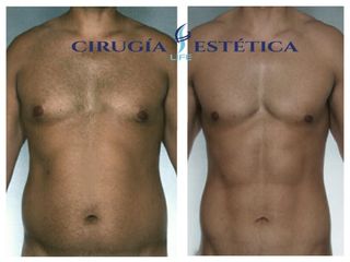 Lipomarcación abdominal y pectoral. De alta definición 