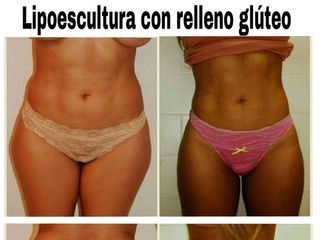Lipoescultura 