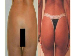 Lipoescultura con Lipotransferencia 