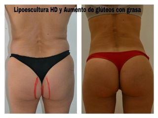 Lipoescultura con Lipotrasferencia glutea