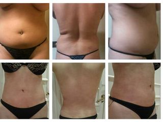 Lipoescultura con minidermolipectomia