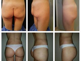Lipotransferencia para atrofia glutea