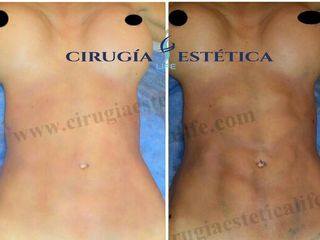 Lipoescultura HD de alta definición 