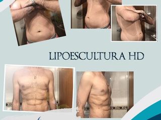 Marcación abdominal