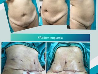 Abdominoplastía 