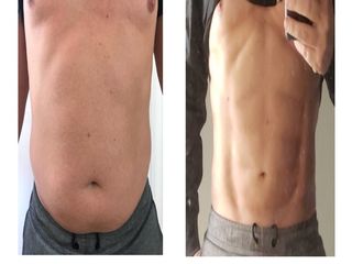 Marcación abdominal 