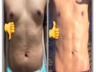 Marcación abdominal 