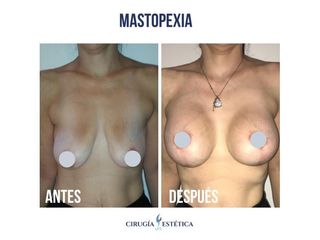 Mastopexia