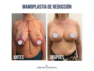 Reducción de mamas