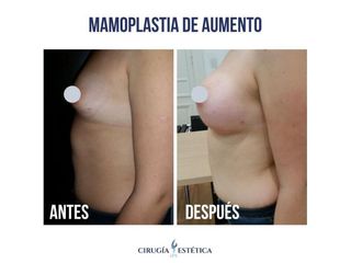 Aumento mamas