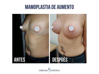 Aumento mamas