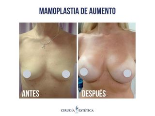 Aumento mamas