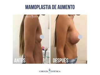 Aumento mamas