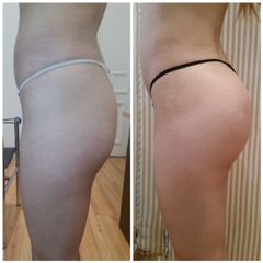 Aumento Glúteos Cirugía Estética Life