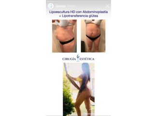 Lipoescultura HD con Abdominoplastia + LipoGlútea