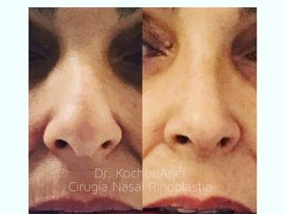 Rinoplastia