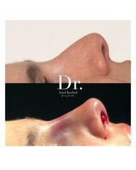 Rinoplastia Pre y Post