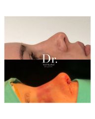 Rinoplastia Antes y Después