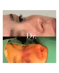 Rinoplastia Antes y Después