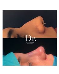 Rinoplastia Antes y Después