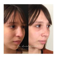 Rinoplastia - Dr. Ariel Kochol