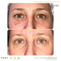 Blefaroplastia - Doctor Lódolo