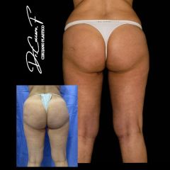Liposucción - Dr. Federico Coccaro