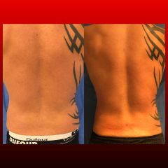 Liposucción - Dr. Federico Coccaro