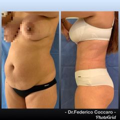Abdominoplastia - Dr. Federico Coccaro