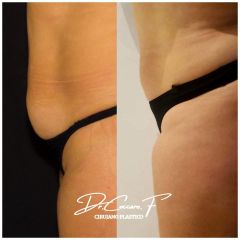 Abdominoplastia - Dr. Federico Coccaro